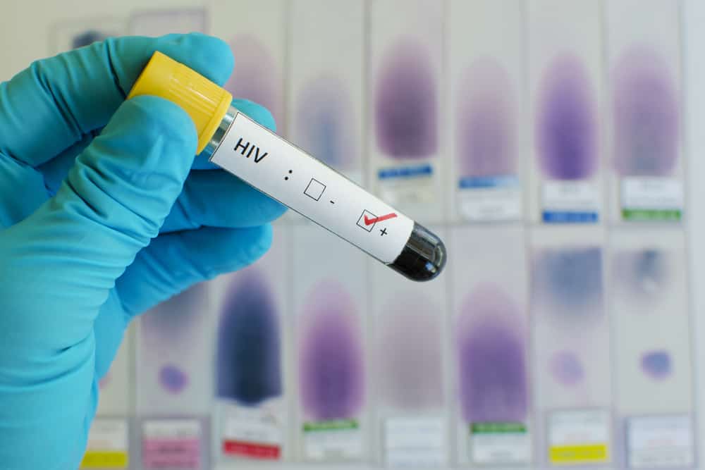 virus hiv cần được xét nghiệm để phát hiện