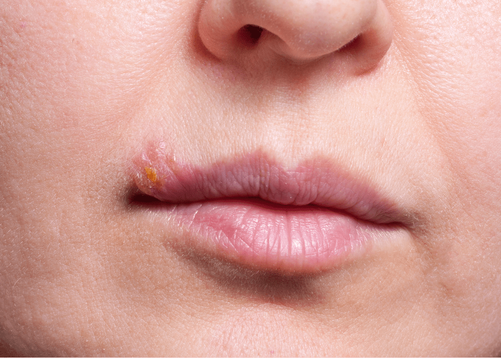 Triệu chứng herpes môi