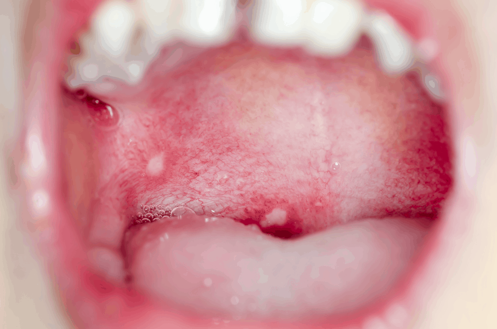 herpes miệng