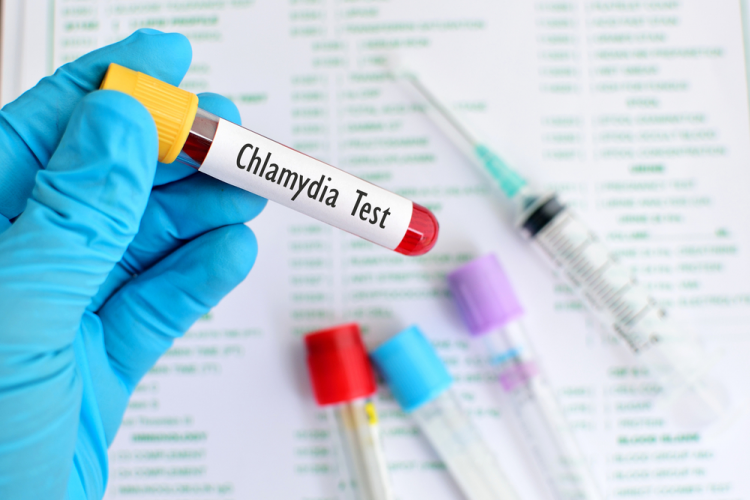 Chẩn đoán bệnh chlamydia